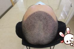 -大麦微针植发丨全国连锁