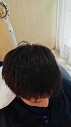-大麦微针植发丨全国连锁