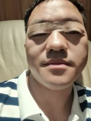 体验后-Yestar宁波艺星整形医院