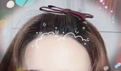 -大麦微针植发全国连锁