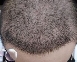 -大麦微针植发丨全国连锁