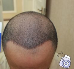 -大麦微针植发丨全国连锁