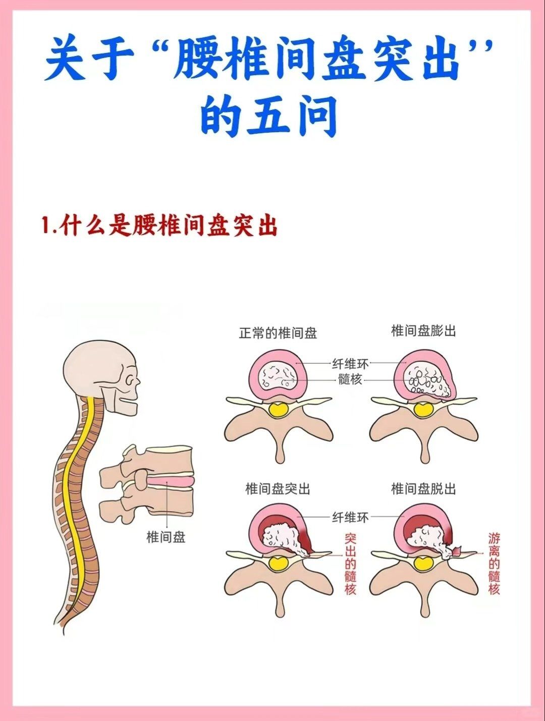 腰间盘突出的原因,你知道吗?
腰椎间