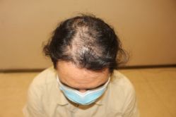 -大麦微针植发丨全国连锁