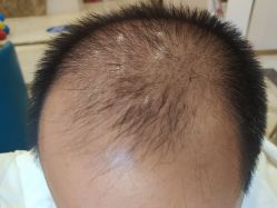 -碧莲盛·不剃发植发