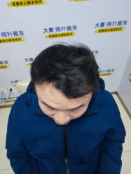 -大麦微针植发丨全国连锁