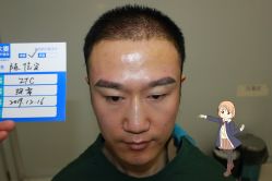 -大麦微针植发丨全国连锁