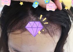 -大麦微针植发全国连锁