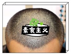 -大麦微针植发全国连锁