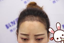 点击看大图 -大麦微针植发丨全国连锁