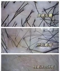 -润复丝·泽发防脱头皮管理