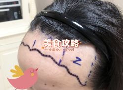 -大麦微针植发全国连锁