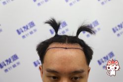 -大麦微针植发丨全国连锁