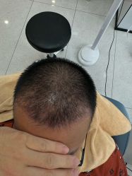 -大麦微针植发丨全国连锁