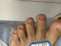 -派恩宜灰指甲甲沟炎(世贸店)