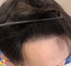 -大麦微针植发丨全国连锁