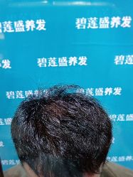 -碧莲盛·不剃发植发