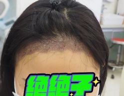 -大麦微针植发丨全国连锁