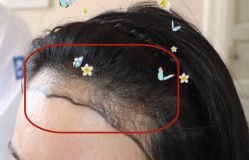 -大麦微针植发全国连锁