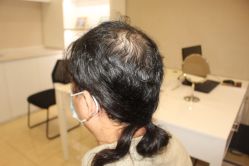 -大麦微针植发丨全国连锁