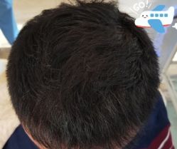-大麦微针植发全国连锁