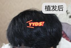 -大麦微针植发全国连锁