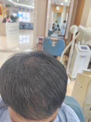 -大麦微针植发全国连锁