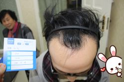 -大麦微针植发丨全国连锁