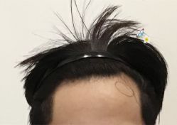 -大麦微针植发全国连锁