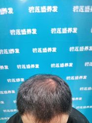 -碧莲盛·不剃发植发