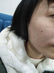 -北京美痣堂古方祛痣斑疣瘊