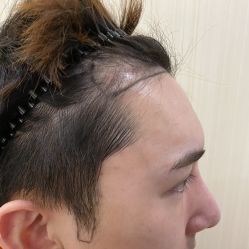 -碧莲盛·不剃发植发