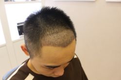 -大麦微针植发丨全国连锁