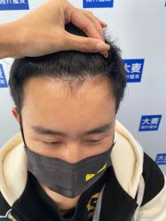 体验后-大麦微针植发全国连锁