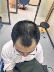 -大麦微针植发全国连锁