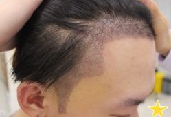 -大麦微针植发丨全国连锁