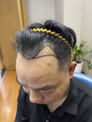 体验前-大麦微针植发全国连锁