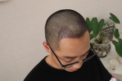 -大麦微针植发丨全国连锁