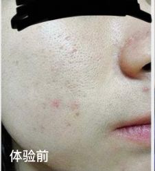 体验前-杭州星婉馨悦医疗美容