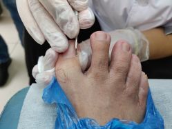 -派恩宜灰指甲鸡眼嵌甲手足癣