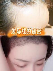 -大麦微针植发全国连锁