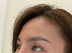 体验后-海涛医疗美容·面部抗衰·注射美鼻