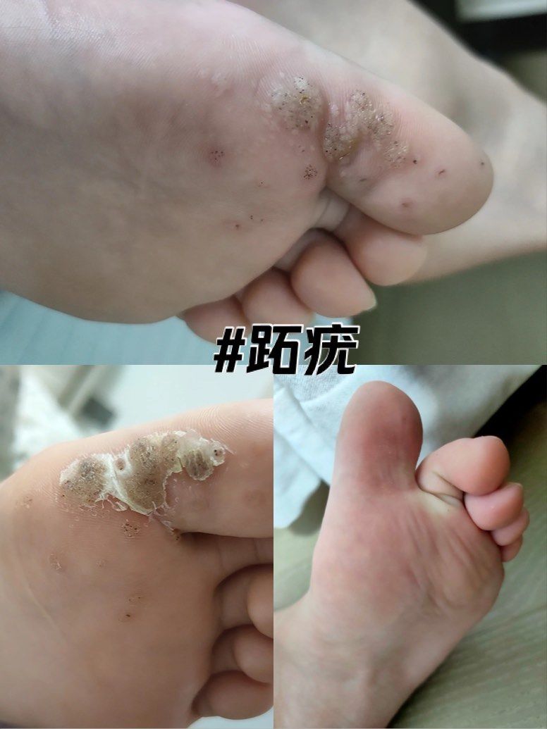 」小妙招祛除跖疣不在话下🥳
跖疣是属于hpv的一种