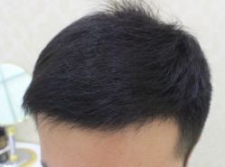 -大麦微针植发全国连锁