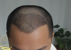 -大麦微针植发丨全国连锁