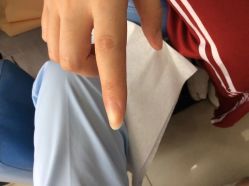 -德哥灰指甲脚气甲沟炎跖疣护理