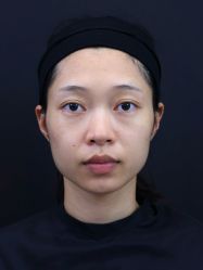 体验前-南宁华美医疗美容医院