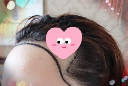 -大麦微针植发全国连锁