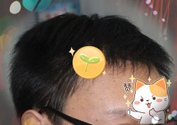-大麦微针植发全国连锁