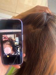 -碧莲盛·不剃发植发